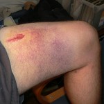 leg injury while on the road